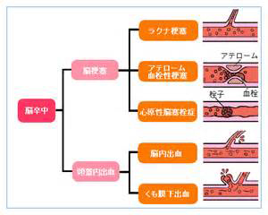 脳卒中について