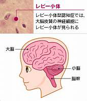 認知症について