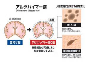 認知症について