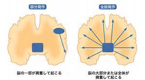 てんかんについて