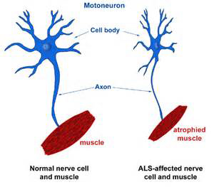 筋萎縮性側索硬化症（ALS）について