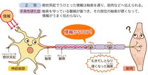 多発性硬化症（ＭＳ）について