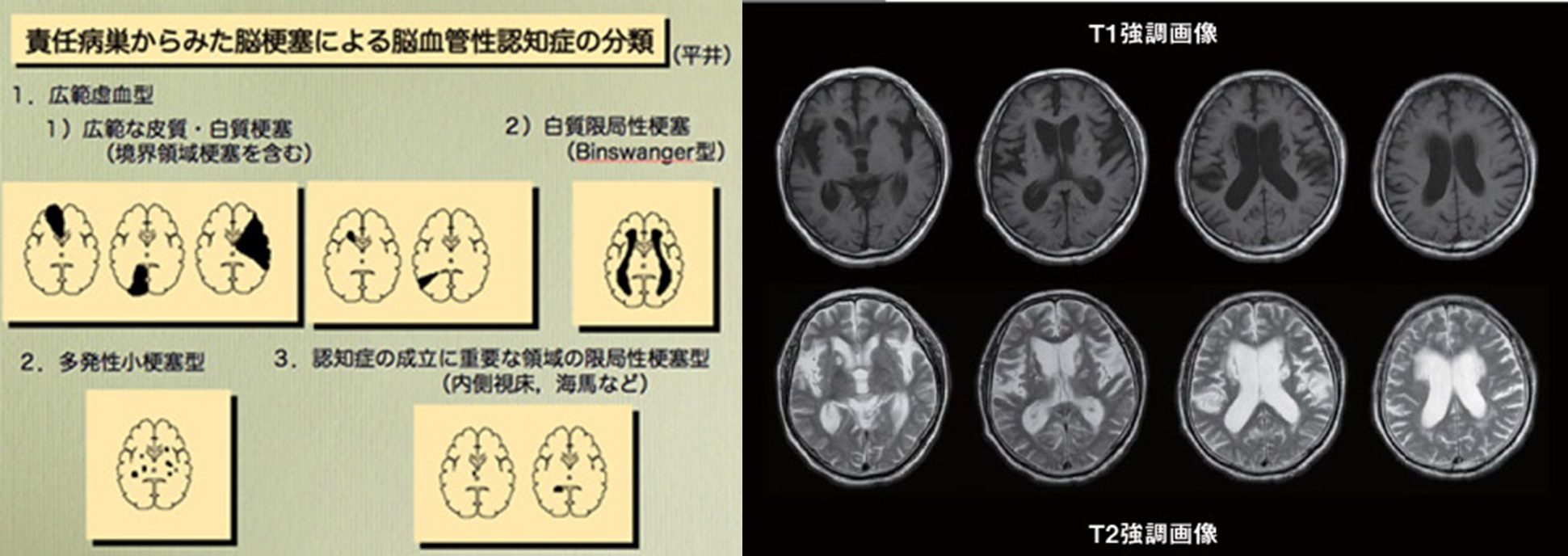 認知症について